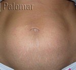 Abdominal after treatment