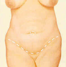 abdominop-fig-2