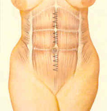 abdominopl-fig-4