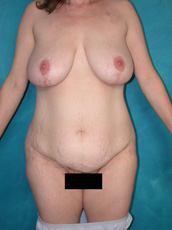 Abdominoplasty