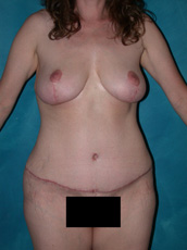 Abdominoplasty