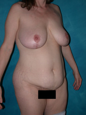 Abdominoplasty