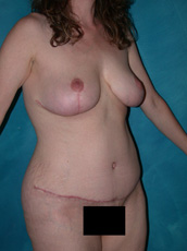 Abdominoplasty