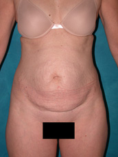 Abdominoplasty