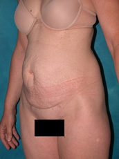 Abdominoplasty