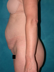 Abdominoplasty