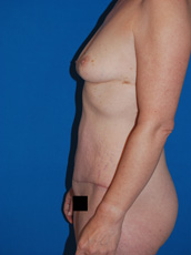 Abdominoplasty