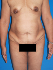 Abdominoplasty