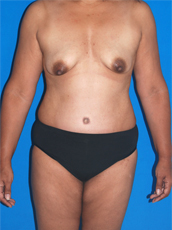 Abdominoplasty