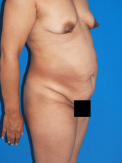 Abdominoplasty