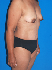 Abdominoplasty