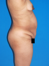 Abdominoplasty