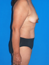 Abdominoplasty