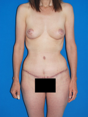 Abdominoplasty and mastopexy