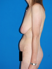 Abdominoplasty and mastopexy