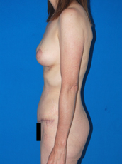 Abdominoplasty and mastopexy