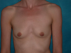 Breast Augmentation