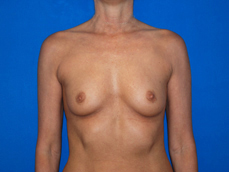 Breast Augmentation