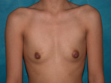 Breast Augmentation