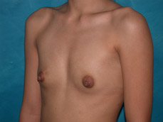 Breast Augmentation