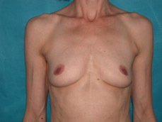 Breast Augmentation