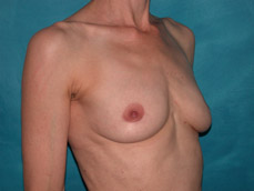 Breast Augmentation