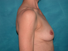 Breast Augmentation