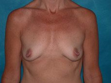 mastopexy and augmentation