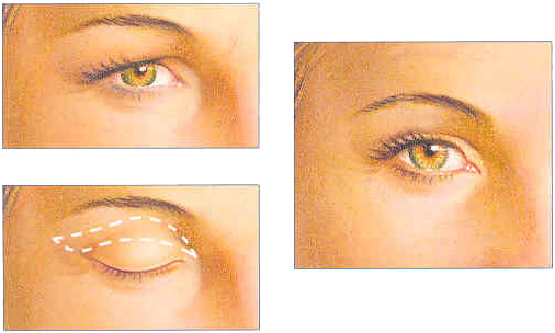 Blepharoplasty