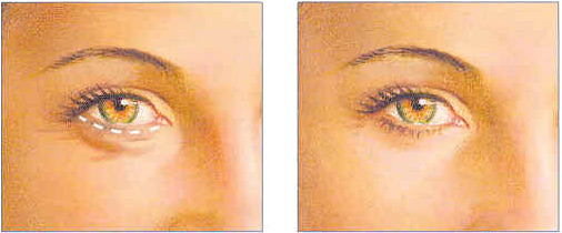 Blepharoplasty