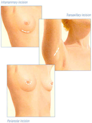 breast-aug-fig-3