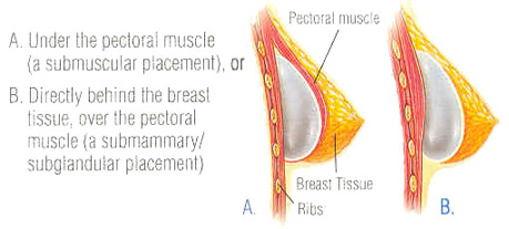 breast-aug-fig-4