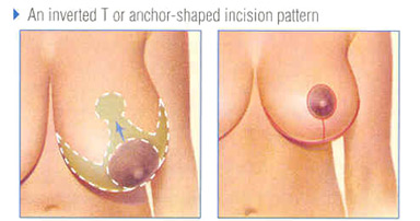 Wise Pattern Breast Reduction