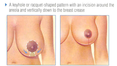 Short Scar Breast Reduction