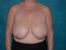 Breast Reduction