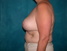 Breast Reduction