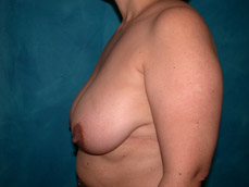 Breast Reduction