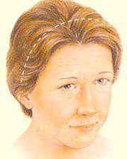 Browlift