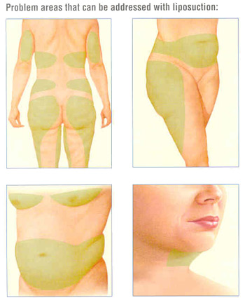 Liposuction of the abdomen and flanks, Plastic Surgeon San Francisco