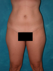 Liposuction