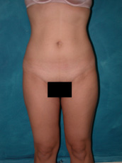 Liposuction