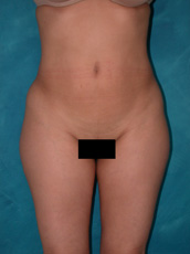 Liposuction