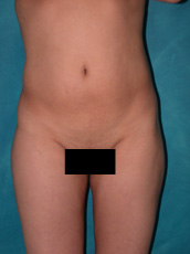 Liposuction