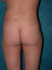 Liposuction