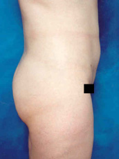 Liposuction