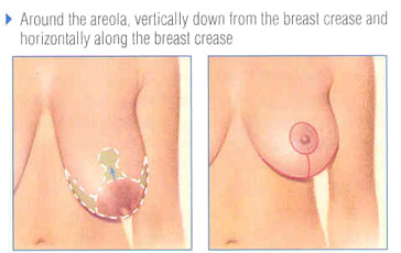 mastopexy-fig-3