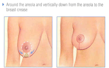 mastopexy-fig-4