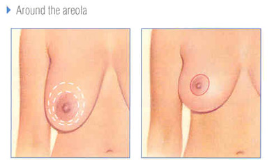 mastopexy-fig-5